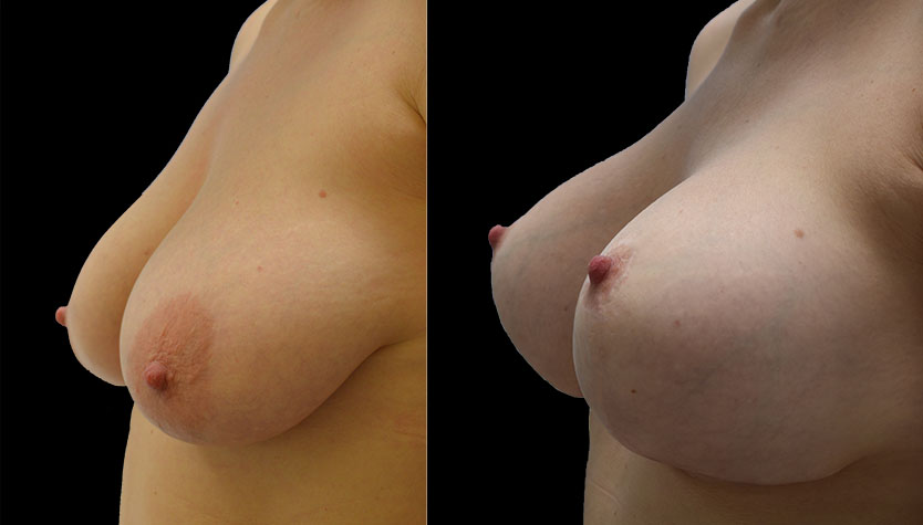 Bröstlyft + implantat